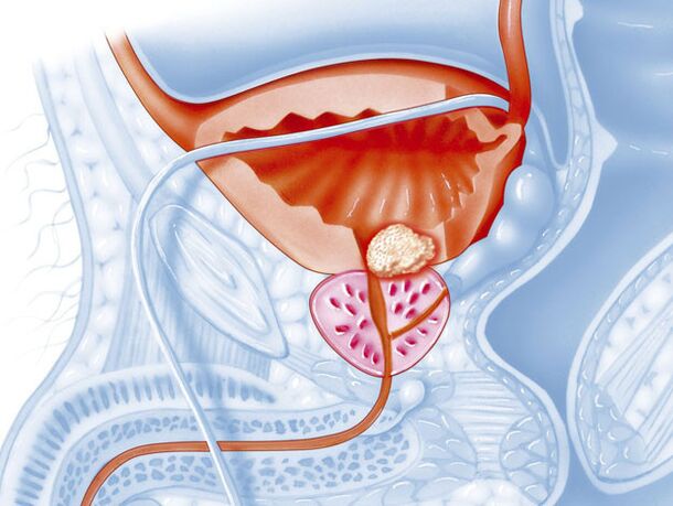 A bacterial form of prostatitis